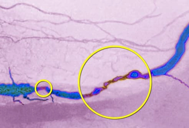 Peripheral Artery Disease