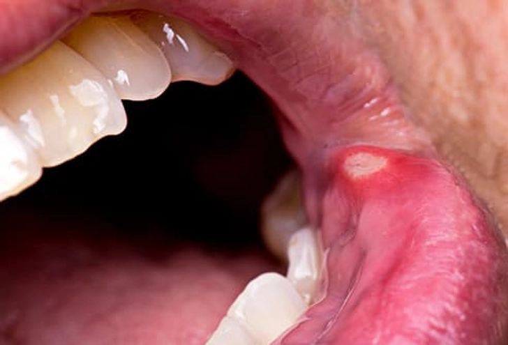 Canker Sore