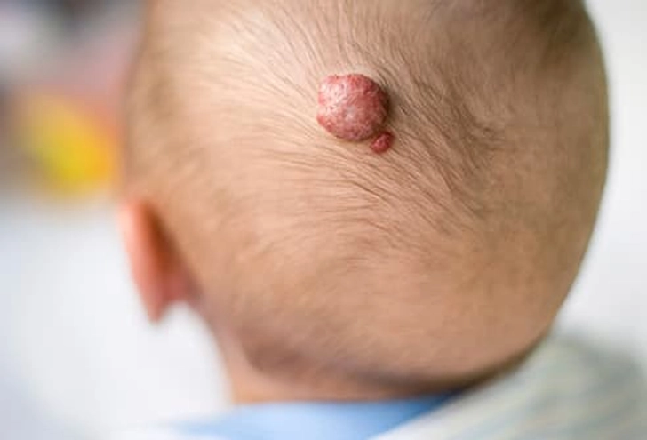 Hemangioma