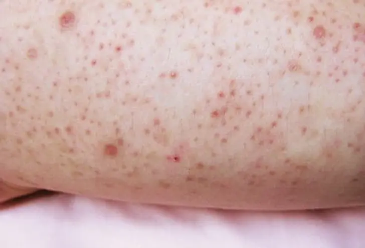 Keratosis Pilaris Keratosis Pilaris