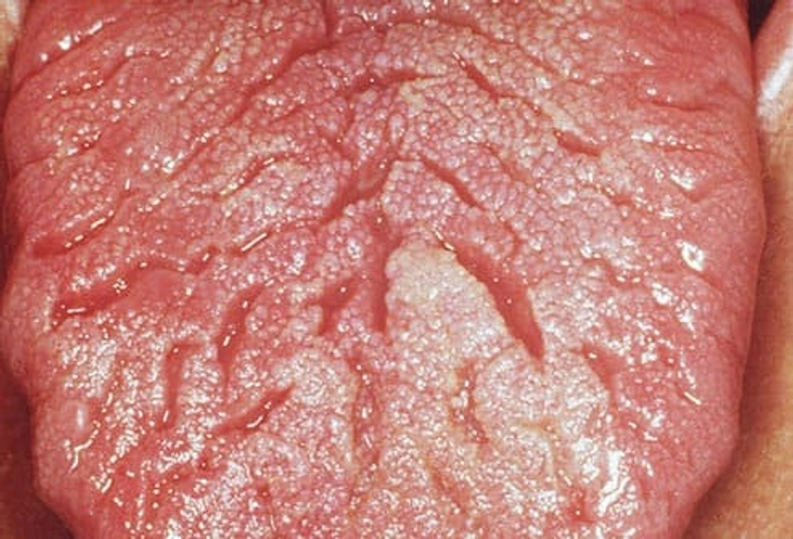Scrotal Tongue