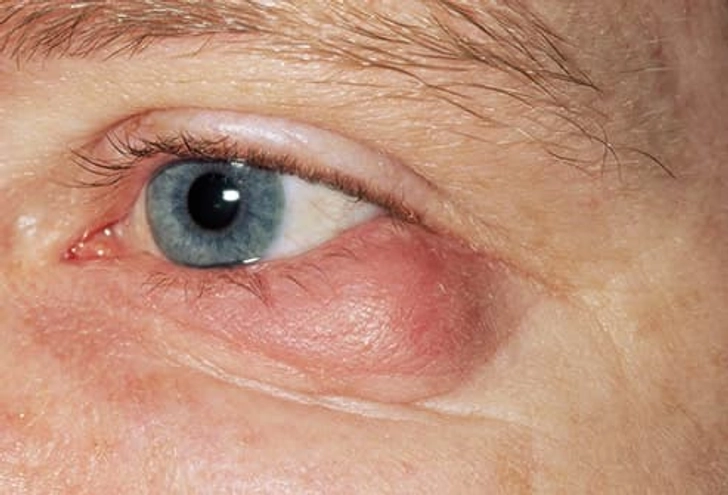 Chalazion Chalazion