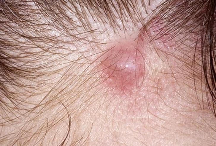 Sebaceous Cysts