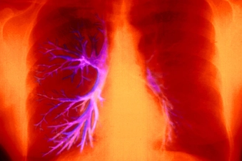 Airway Damage