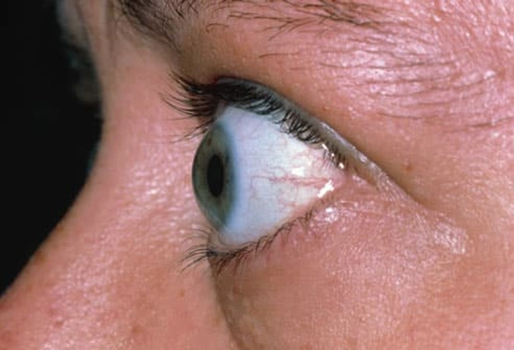 Graves' Disease