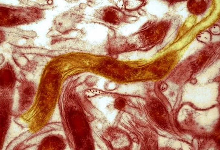 Lyme Disease