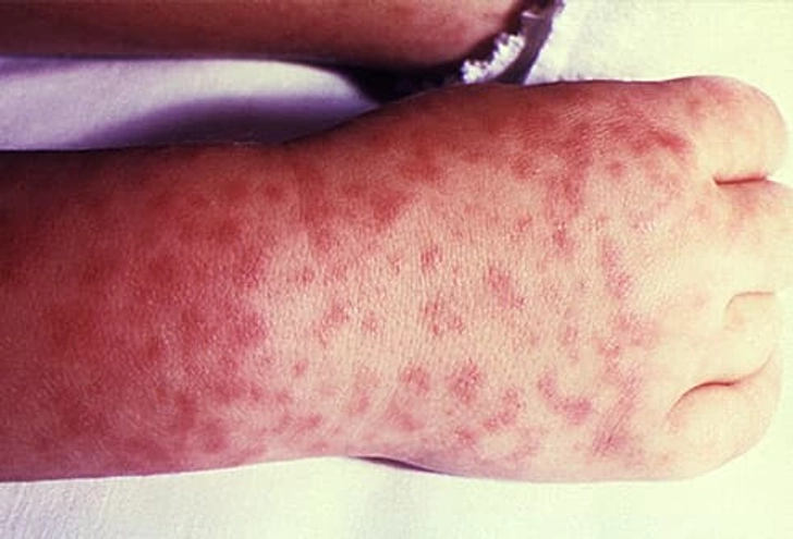 Rocky Mountain Spotted Fever