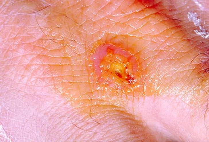 Tularemia