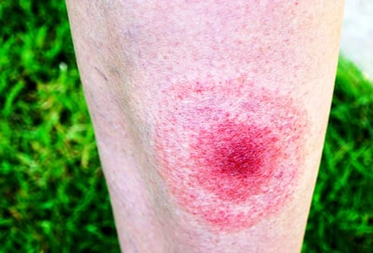 Lyme Disease Symptoms Lyme Disease Symptoms