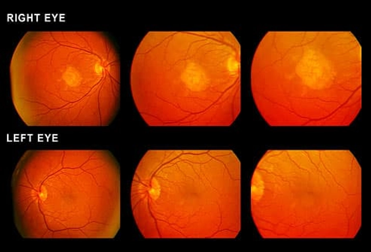 Slowing Down Macular Degeneration