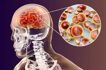 What Is Meningitis, Exactly?