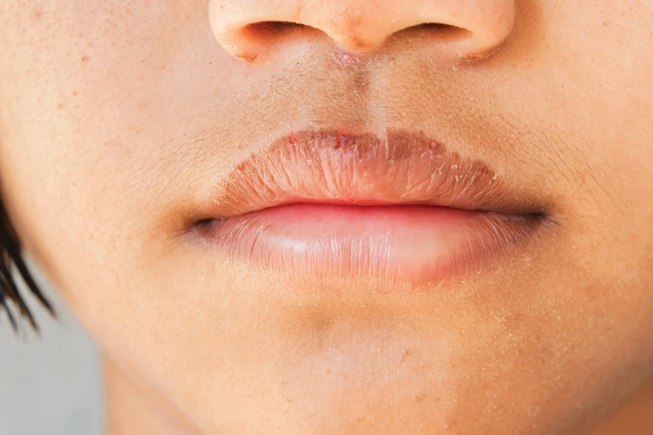 Chapped Lips