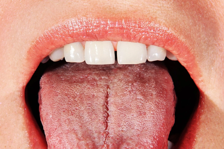 Dry Mouth Dry Mouth