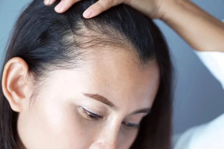 Lupus’s Effects on Your Locks
