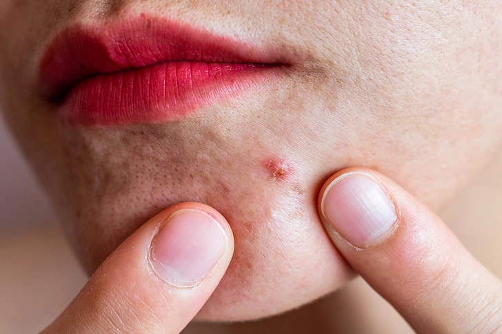 Avoid Picking at Skin Avoid Picking at Skin