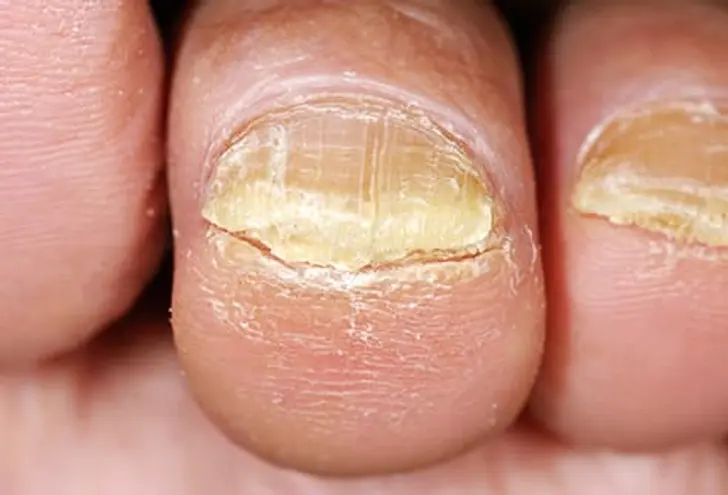 What Is Toenail Fungus?