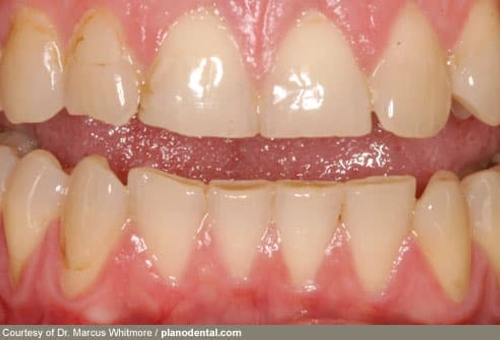 Grinding Teeth