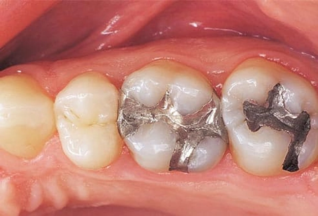 6. Cracked Tooth