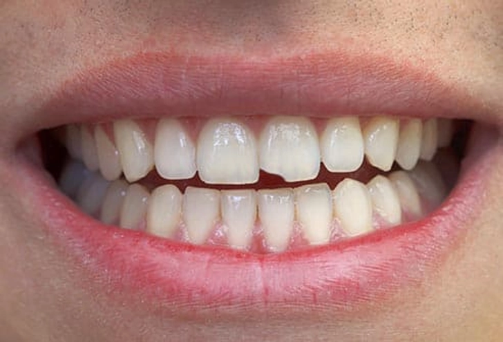 4. Chipped Tooth