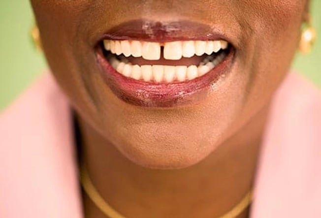 10. Gap Between Teeth