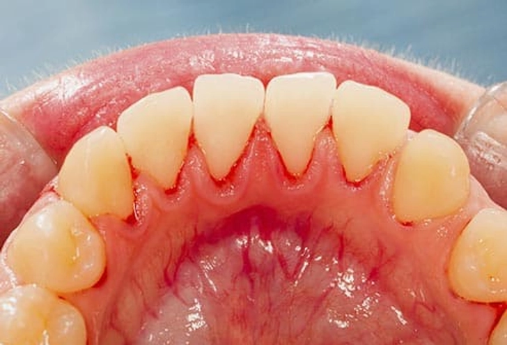 11. Gum Problems