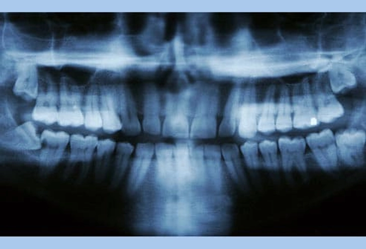 13. Wisdom Teeth Problems