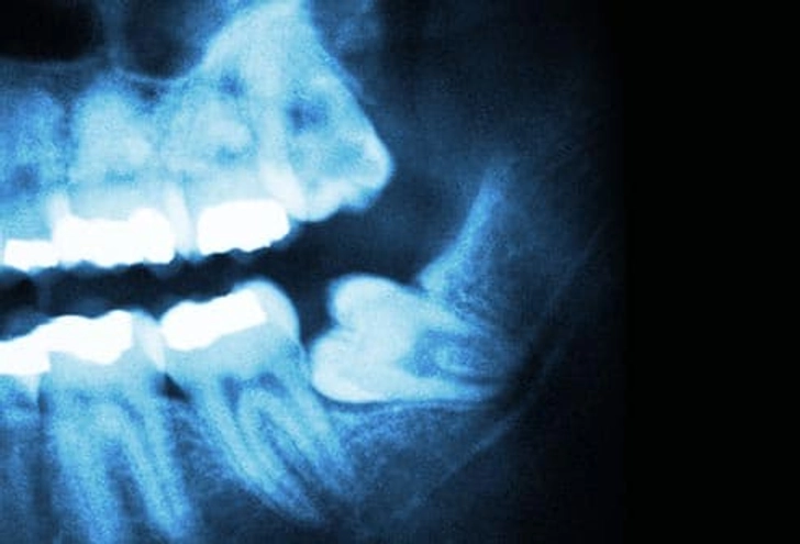 5. Impacted Teeth
