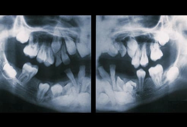 8. Too Many Teeth: Hyperdontia