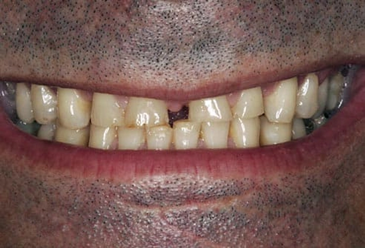 12. Clenching or Grinding Your Teeth