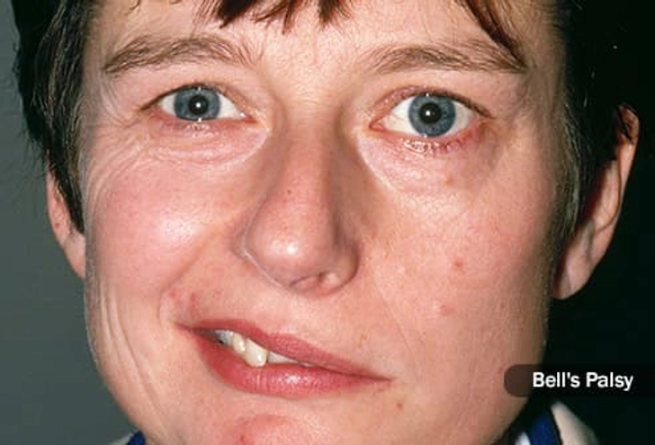 When Eyelid Twitches Don't Go Away