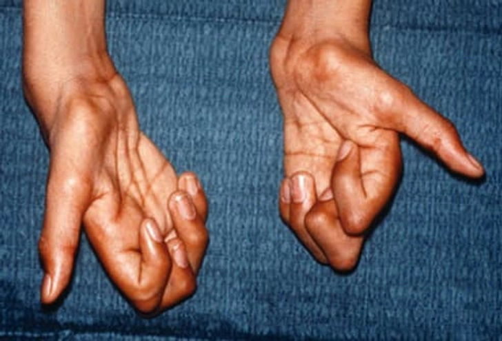 Lou Gehrig's Disease -- Also Known as ALS