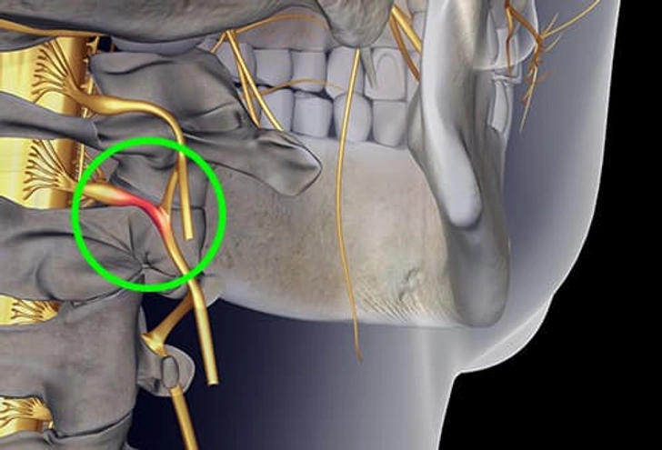 Pinched Spinal Nerve