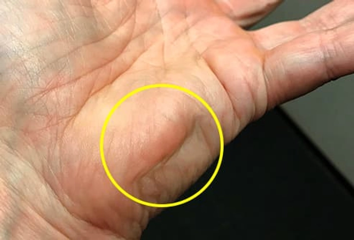 Isaacs’ Syndrome