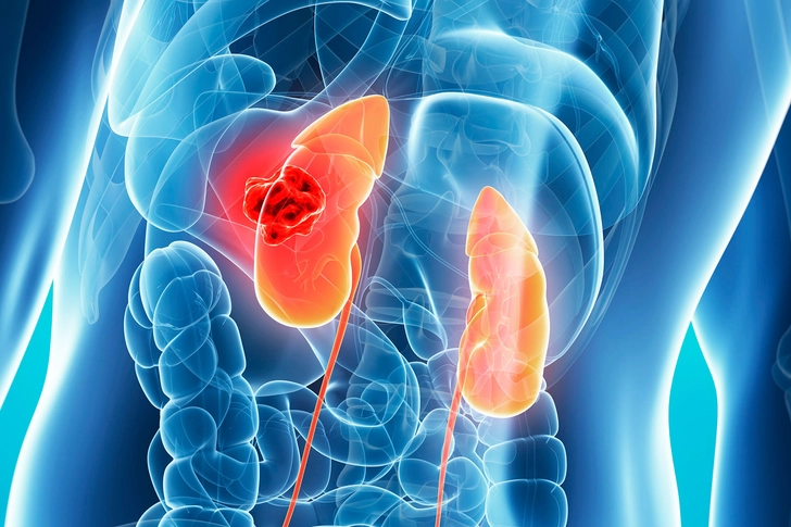Kidney Disease