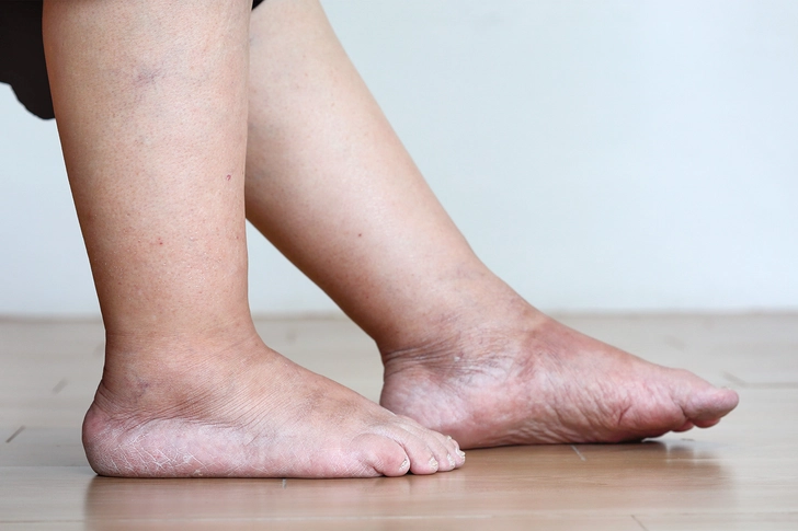 Swelling in Your Hands, Lower Limbs, or Eyelids