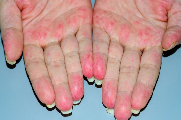 Vasculitis