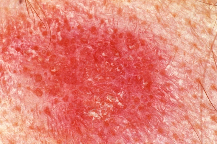 Skin Scarring and Hair Loss