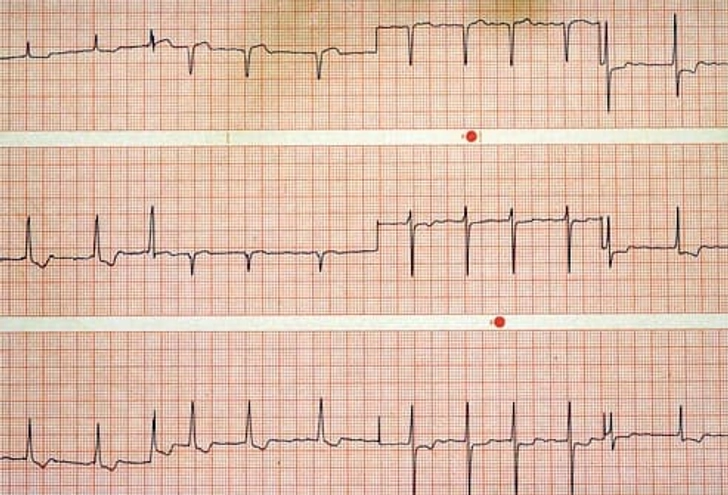 Reset an Irregular Heart Rhythm Reset an Irregular Heart Rhythm