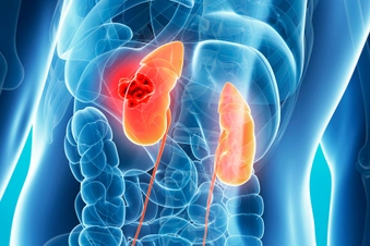 Aldosterone Blockers