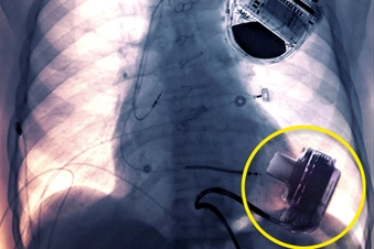 Implantable LVAD