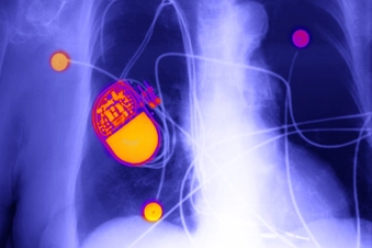 A Pacemaker for Advanced Heart Failure A Pacemaker for Advanced Heart Failure