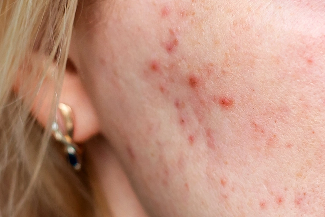 Skin Infections and Acne