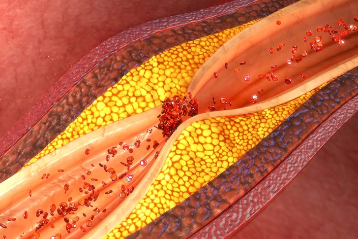 High Cholesterol High Cholesterol