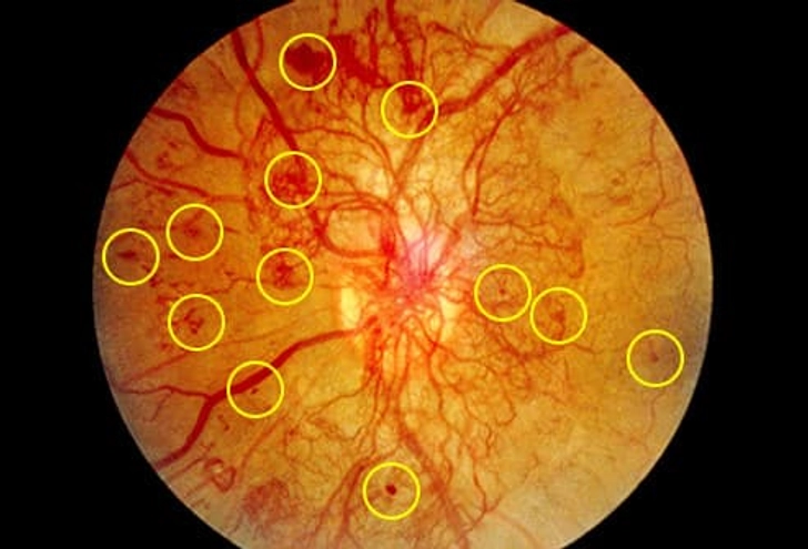 Diabetic Retinopathy