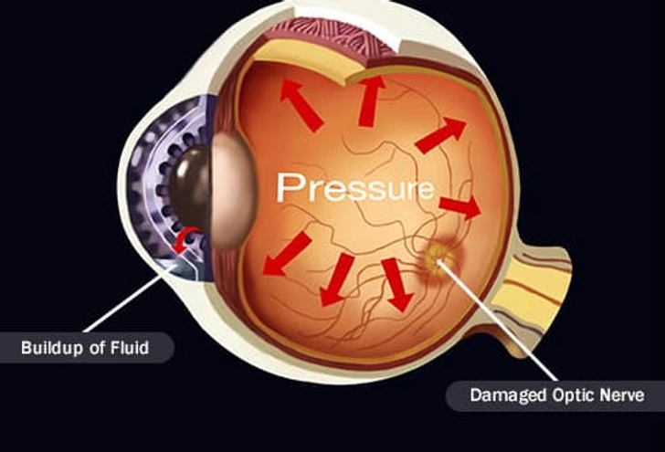 Glaucoma