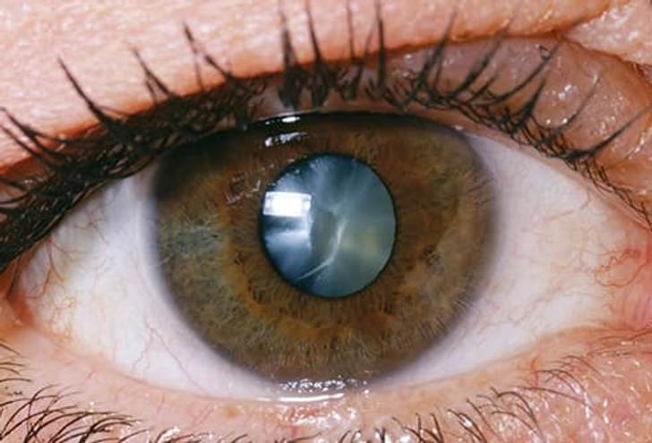 Cataracts Cataracts