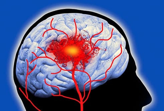 Thrombotic Stroke Thrombotic Stroke