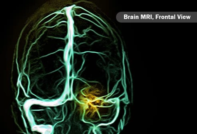 Cerebral Venous Sinus Thrombosis Cerebral Venous Sinus Thrombosis