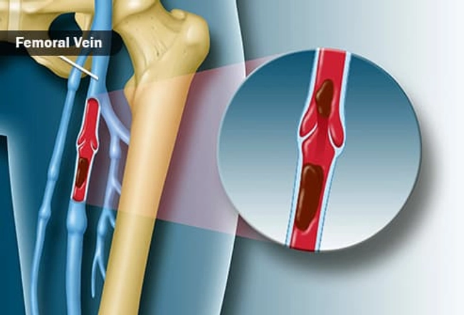 Femoral Vein Thrombosis Femoral Vein Thrombosis