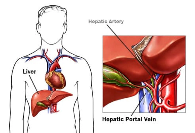 Portal Vein Thrombosis Portal Vein Thrombosis